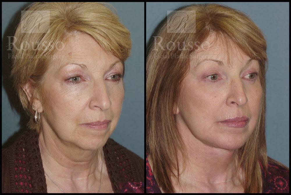 Facelift Before & After Gallery - Patient 2236803 - Image 1