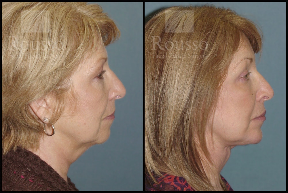 Facelift Before & After Gallery - Patient 2236803 - Image 2