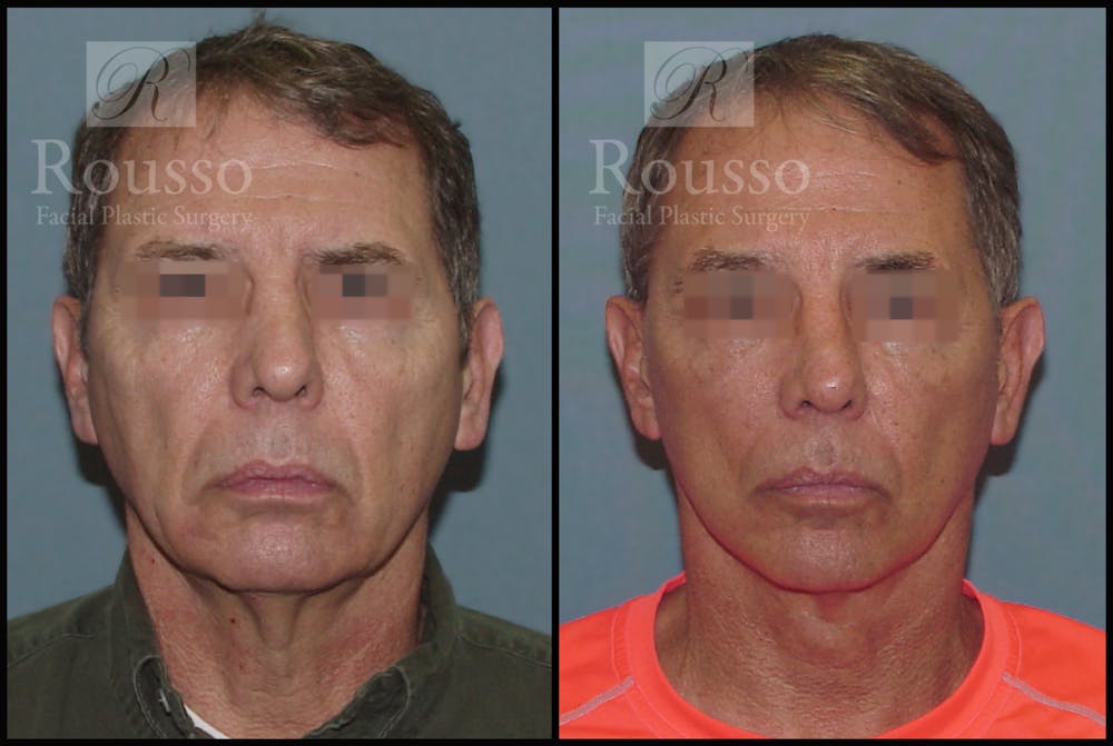 Male Facelift Gallery - Patient 2237411 - Image 1