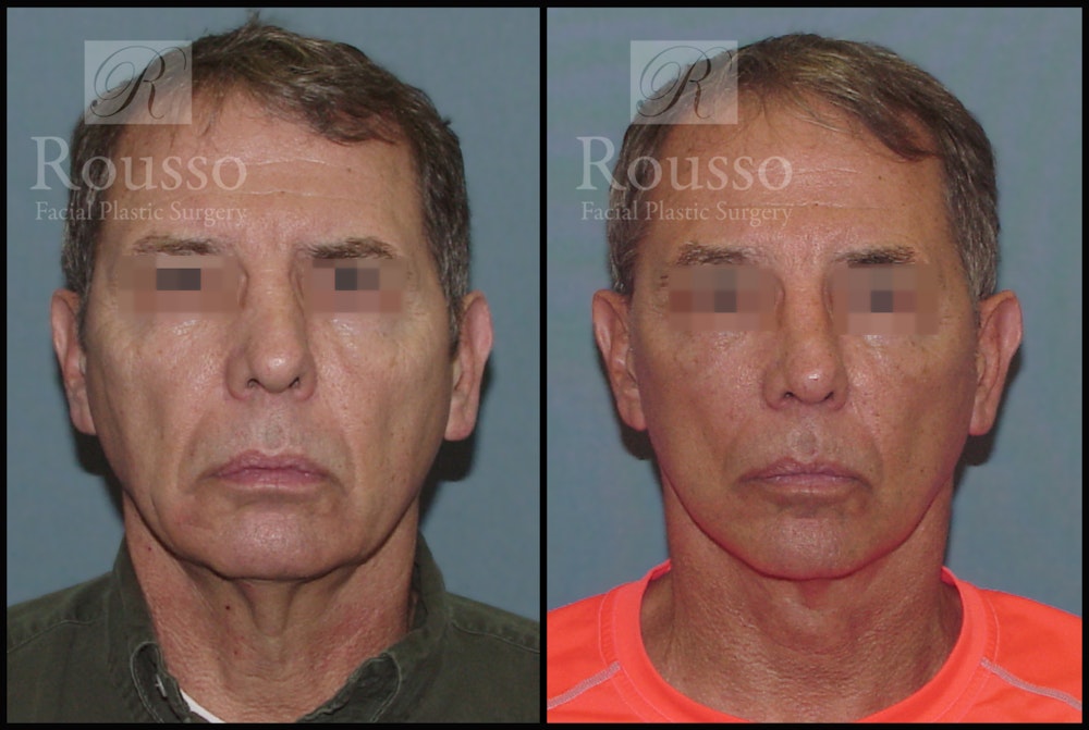 Male Facelift Before & After Gallery - Patient 2237411 - Image 1
