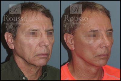 Male Facelift Before & After Gallery - Patient 2237411 - Image 2