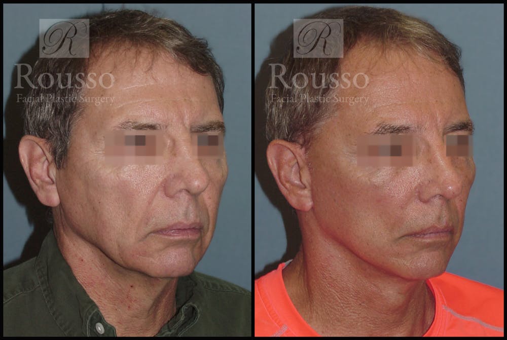 Male Facelift Gallery - Patient 2237411 - Image 2