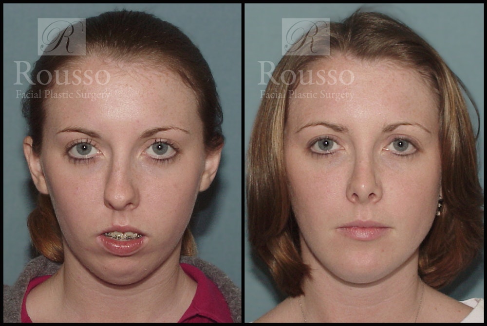 Rhinoplasty Before & After Gallery - Patient 1993299 - Image 2