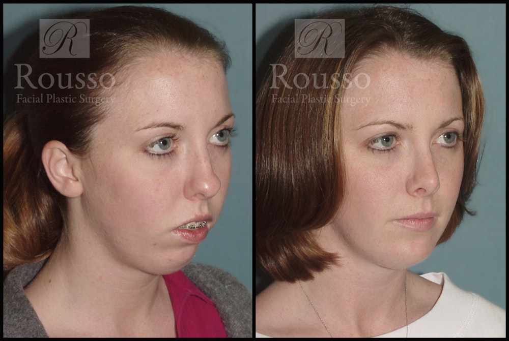 Rhinoplasty Before & After Gallery - Patient 1993299 - Image 1