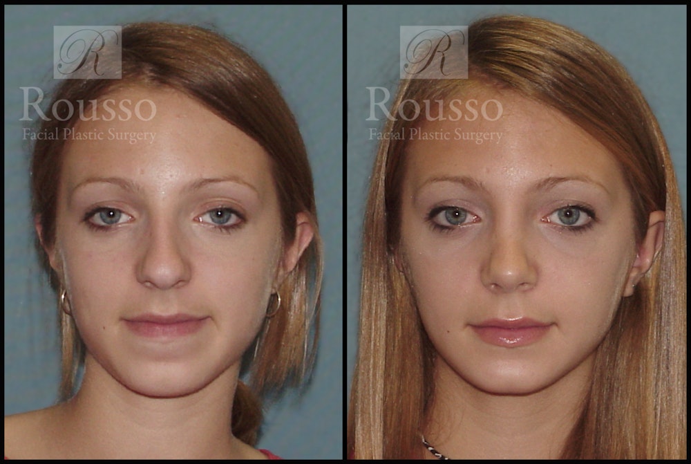 Rhinoplasty Before & After Gallery - Patient 2237784 - Image 2