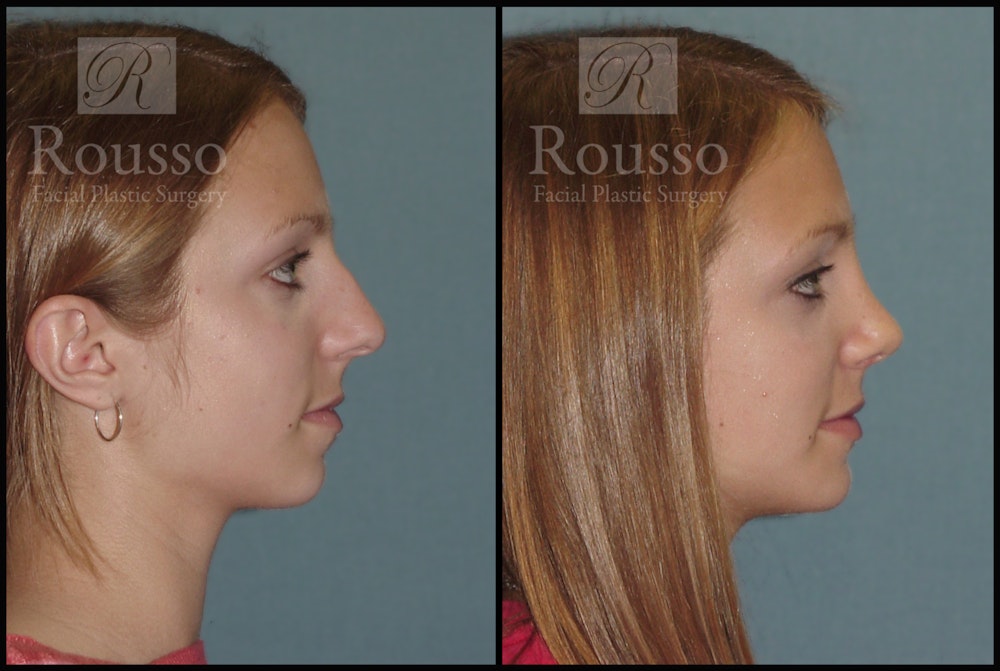Rhinoplasty Before & After Gallery - Patient 2237784 - Image 1