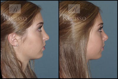 Rhinoplasty <span class=small>By Dr. Daniel Rousso</span> Before & After Gallery - Patient 1993311 - Image 1