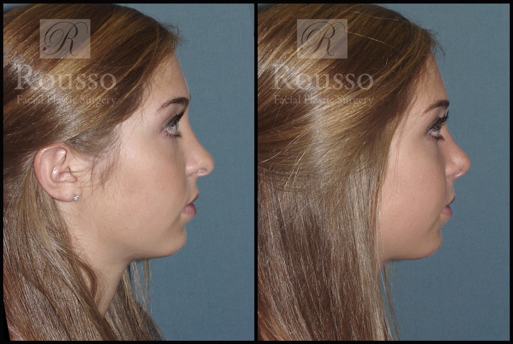 Rhinoplasty <span class=small>By Dr. Daniel Rousso</span> Before & After Gallery - Patient 1993311 - Image 1