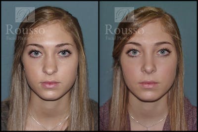 Rhinoplasty Before & After Gallery - Patient 1993311 - Image 2