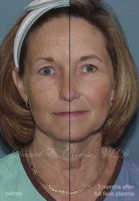 Before and after photo of an actual plasma skin resurfacing patient