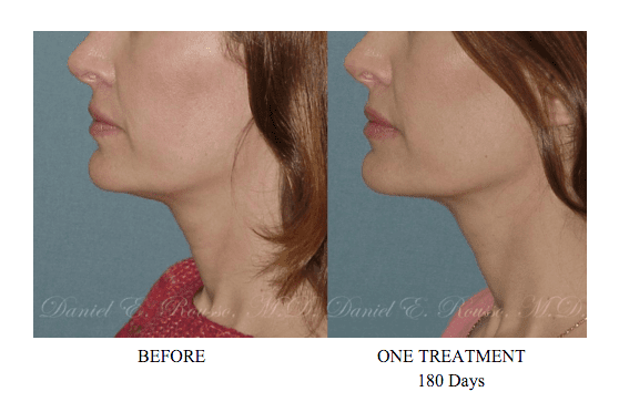 Ultherapy Non Invasive Technology to Subtly Tighten Skin