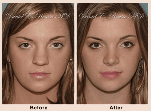 Rhinoplasty Recovery Guide