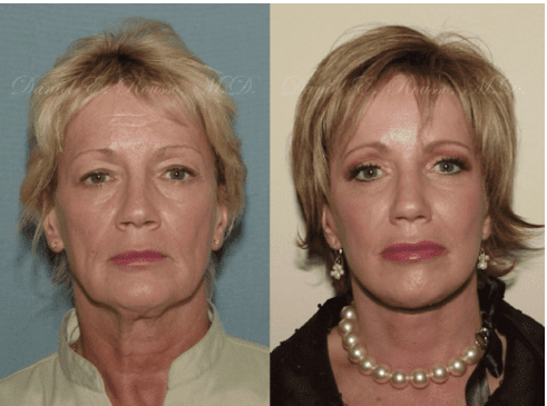 Before and After Traditional Facelift