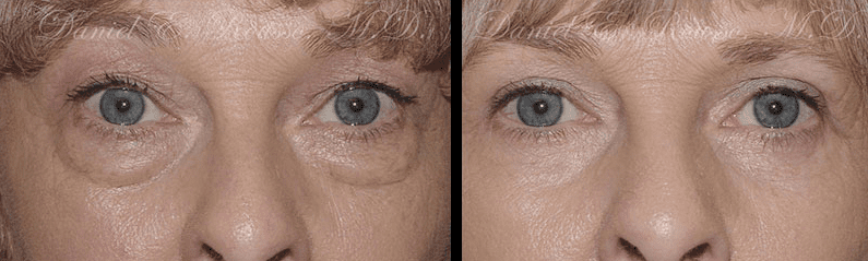 Blepharoplasty Before and After Photos