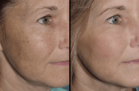 Plasma Skin Resurfacing Before and After Photos