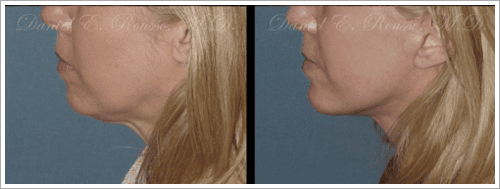 Rousso - Chin implant before and after photos