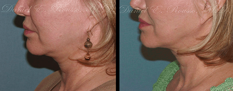 ultherapy before and after