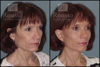 SculptLift™ <span class=small>By Dr. Daniel Rousso</span> Before & After Gallery - Patient 2279582 - Image 1