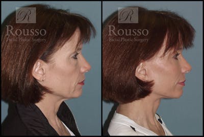 SculptLift™ Before & After Gallery - Patient 2279582 - Image 2