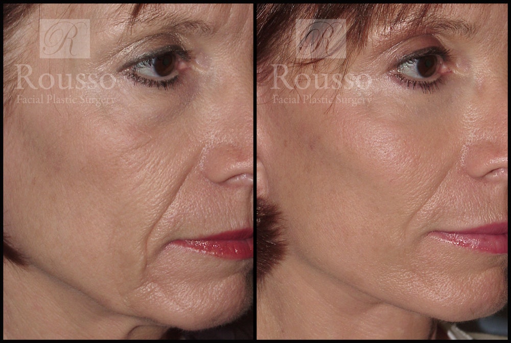 SculptLift™ Before & After Gallery - Patient 2279582 - Image 3