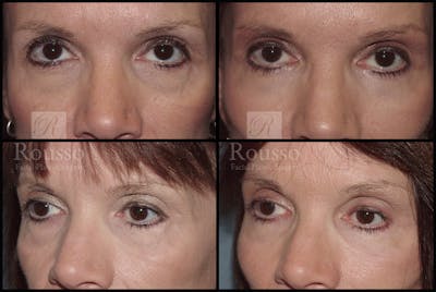 Blepharoplasty <span class=small>By Dr. Daniel Rousso</span> Before & After Gallery - Patient 2279583 - Image 1
