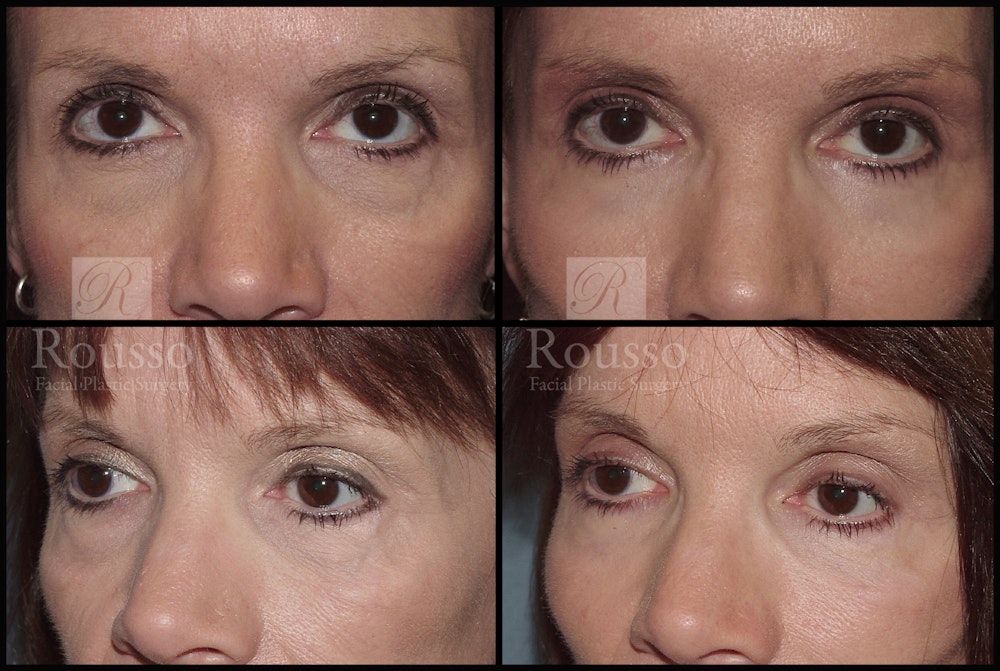 Blepharoplasty Before & After Gallery - Patient 2279583 - Image 1