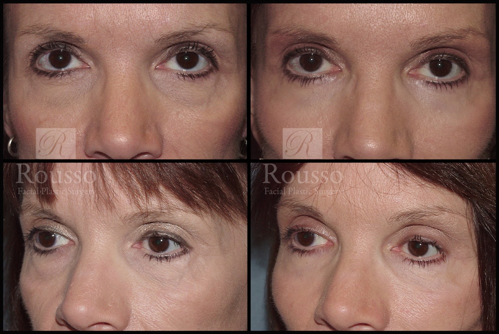 Blepharoplasty <span class=small>By Dr. Daniel Rousso</span> Before & After Gallery - Patient 2279583 - Image 1