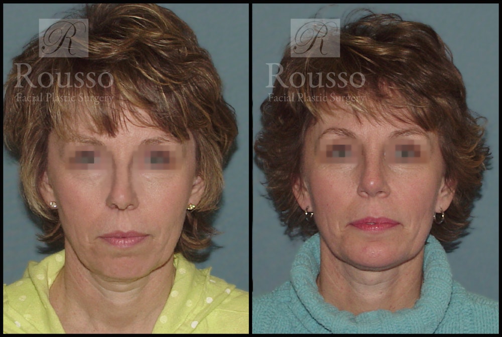 Facial Implants Before & After Gallery - Patient 50832010 - Image 3