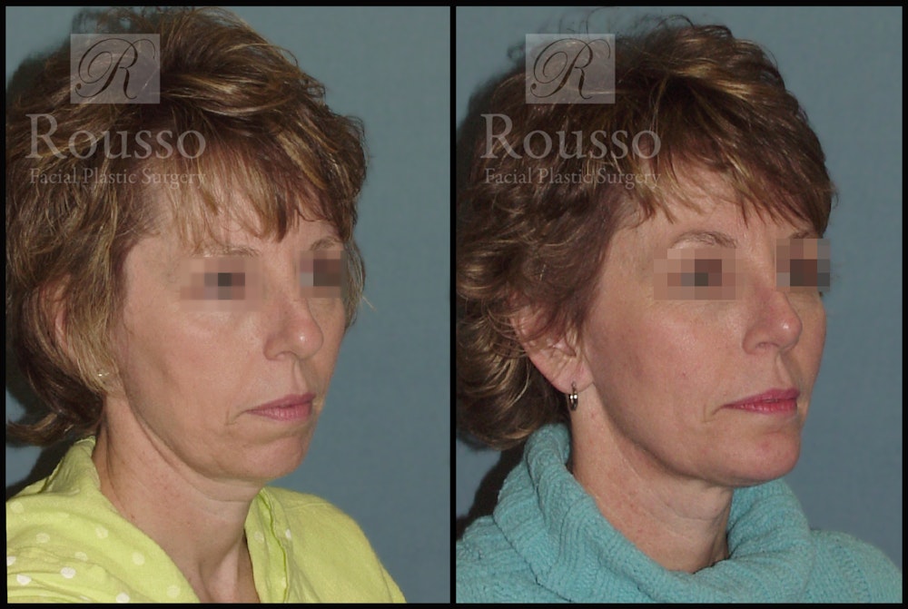 Facial Implants Before & After Gallery - Patient 50832010 - Image 2