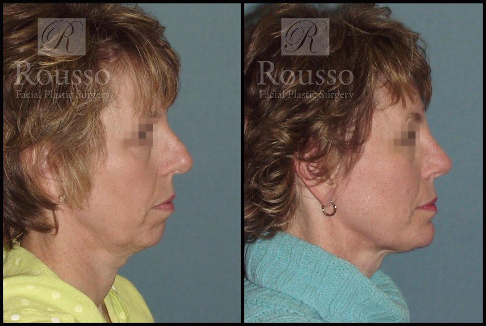 Facial Implants Before & After Gallery - Patient 50832010 - Image 1
