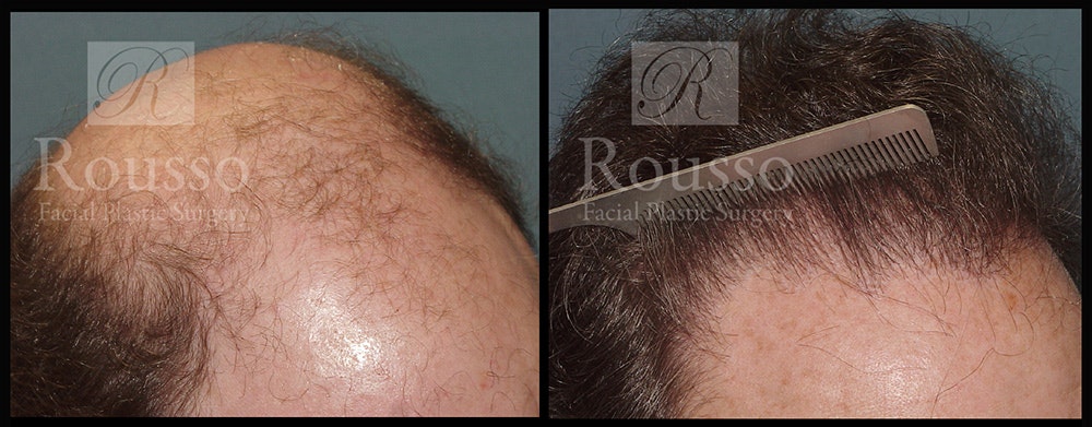 Hair Transplant Before & After Gallery - Patient 2574218 - Image 4