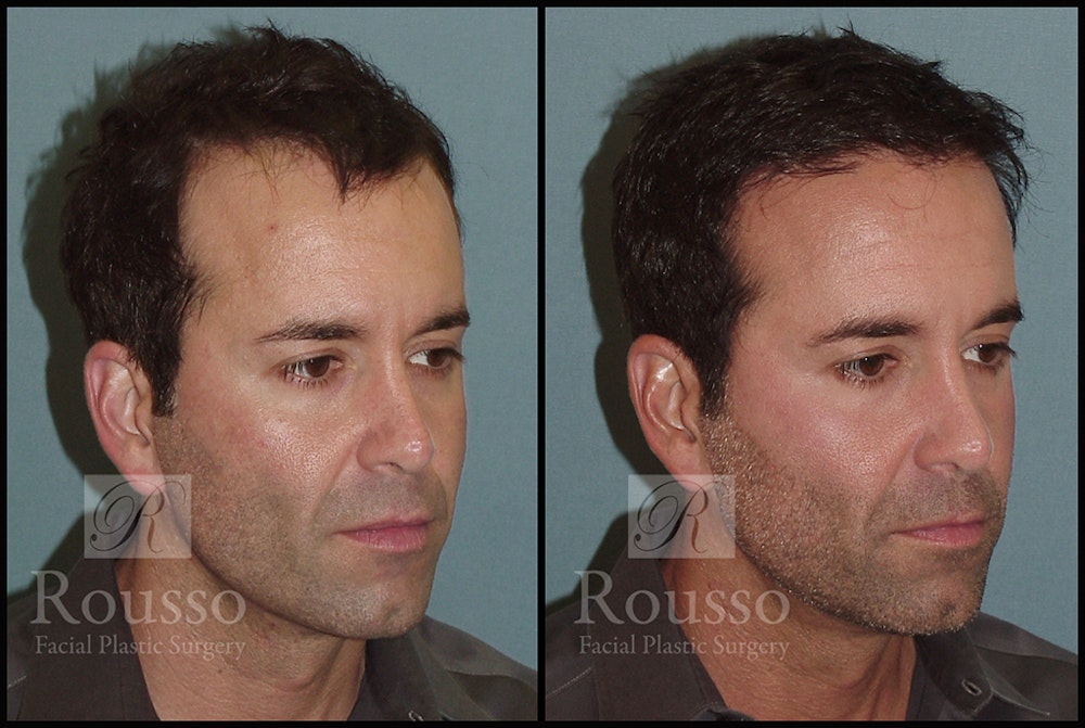 Hair Transplant Before & After Gallery - Patient 2601725 - Image 1