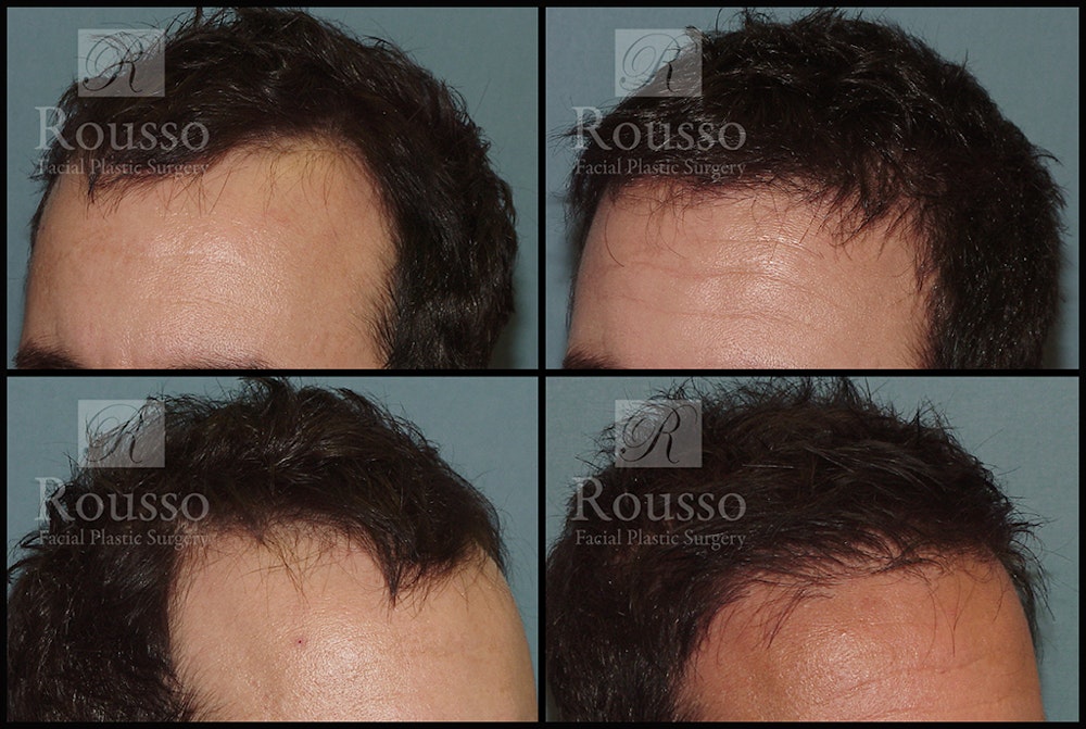 Hair Transplant Gallery - Patient 2601725 - Image 2