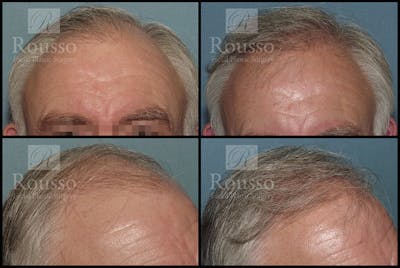 Hair Transplant Gallery - Patient 2601730 - Image 1