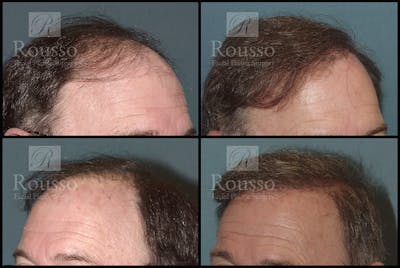 Hair Transplant Gallery - Patient 2601731 - Image 1