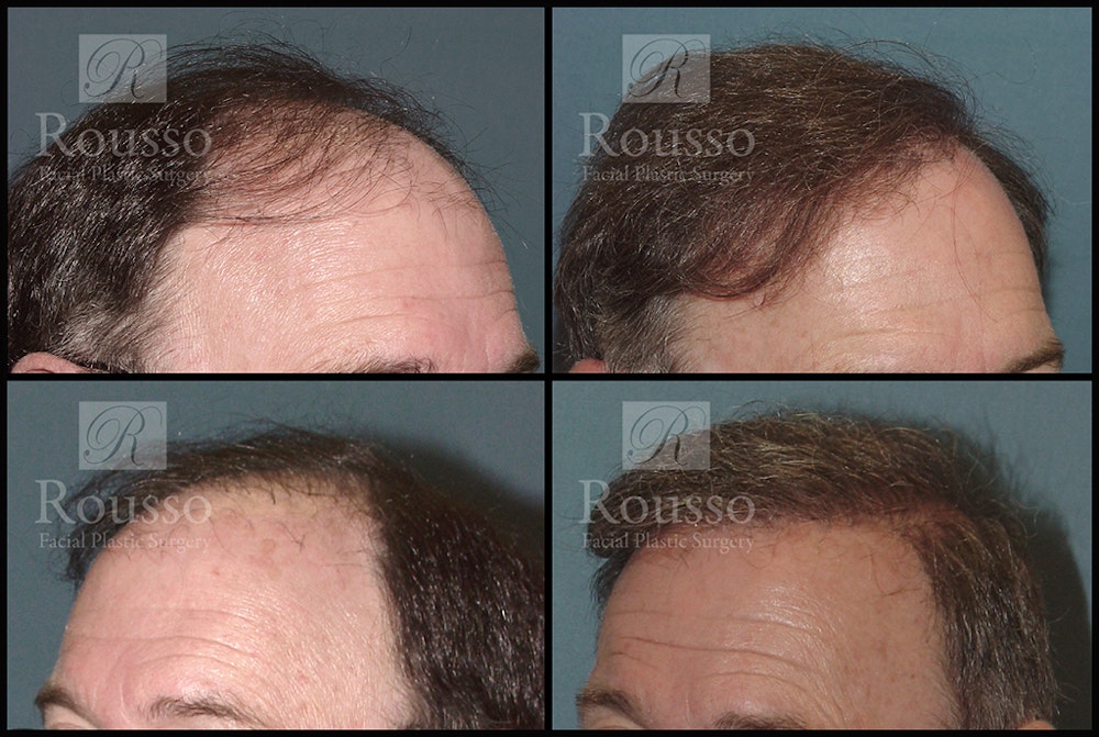 Hair Transplant Before & After Gallery - Patient 2601731 - Image 1