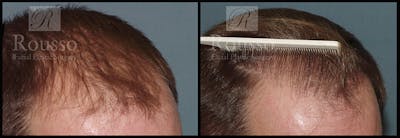 Hair Transplant Before & After Gallery - Patient 2601732 - Image 1