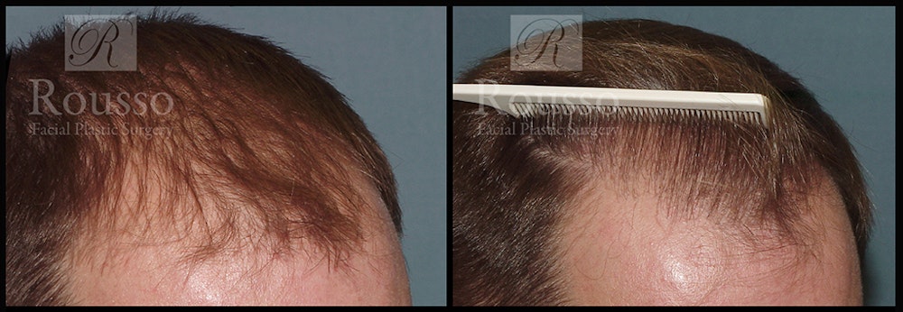 Hair Transplant Before & After Gallery - Patient 2601732 - Image 1