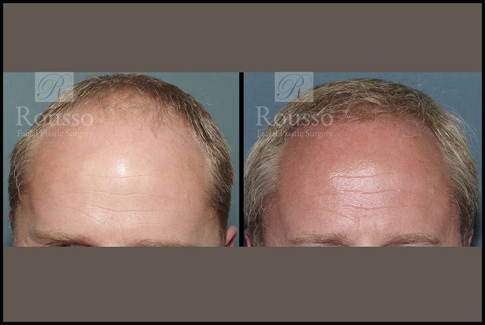 Hair Transplant Before & After Gallery - Patient 2689693 - Image 1