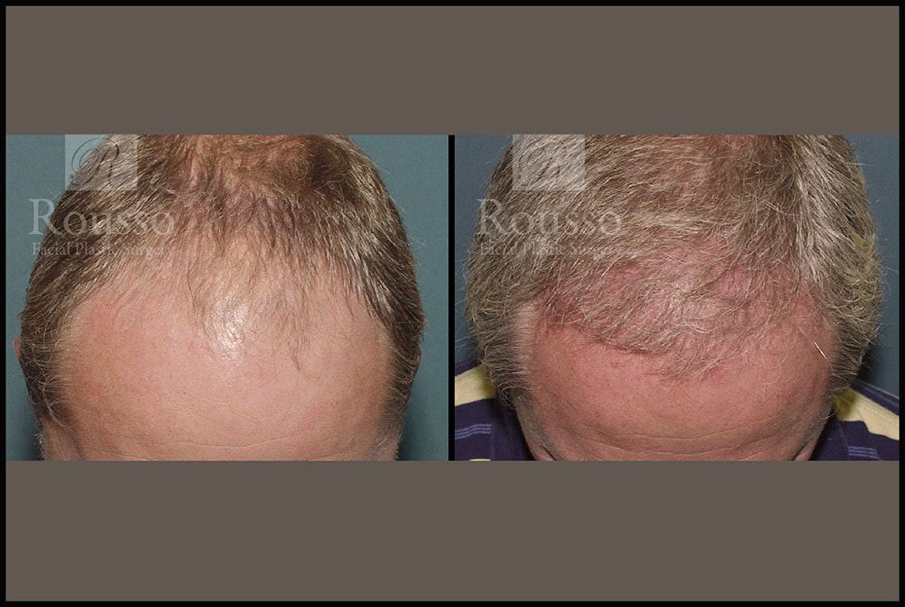 Hair Transplant Gallery - Patient 2689693 - Image 2