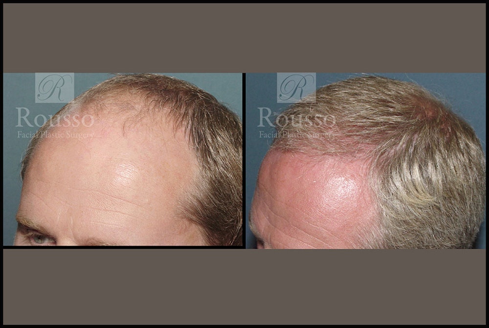 Hair Transplant Before & After Gallery - Patient 2689693 - Image 3