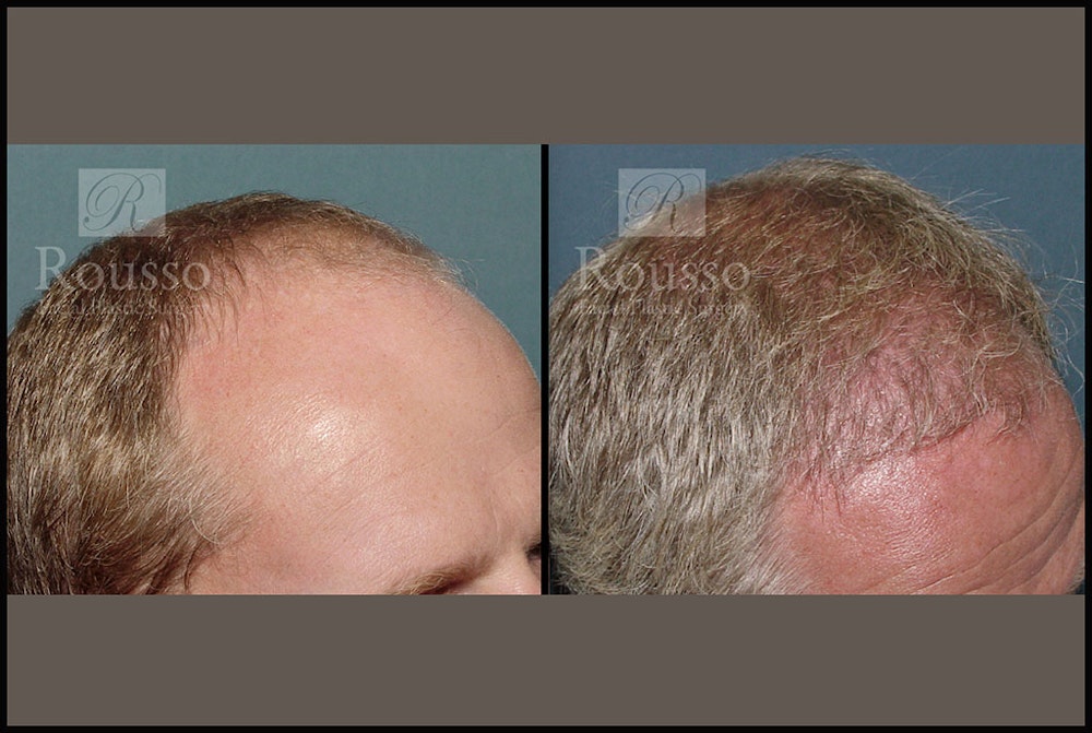 Hair Transplant Before & After Gallery - Patient 2689693 - Image 4