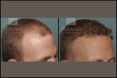 Hair Transplant Before & After Gallery - Patient 2689696 - Image 1