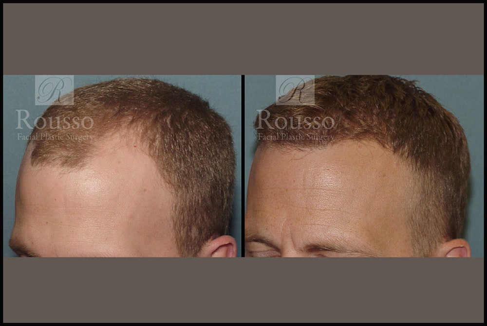 Hair Transplant Gallery - Patient 2689696 - Image 2