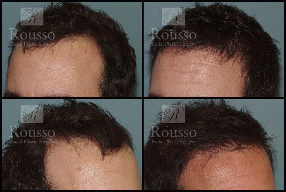 Hair Transplant Before & After Gallery - Patient 2715747 - Image 1