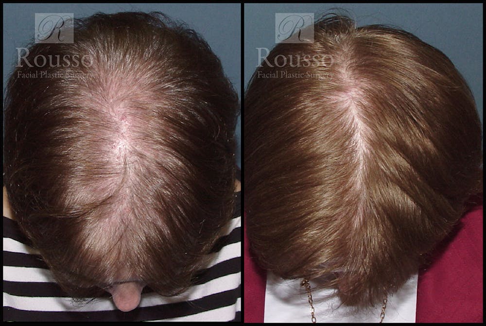 Hair Transplant Gallery - Patient 2715748 - Image 1