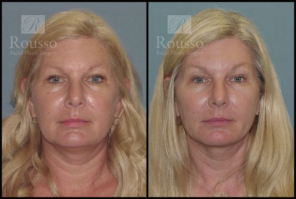 Acculift Before & After Gallery - Patient 2837802 - Image 1