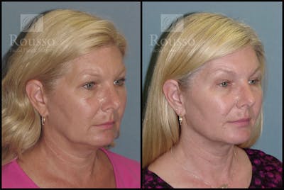 Acculift <span class=small>By Dr. Daniel Rousso</span> Before & After Gallery - Patient 2837802 - Image 2