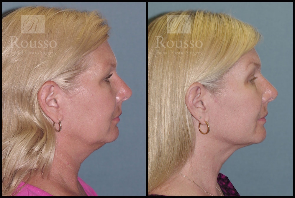 Acculift Before & After Gallery - Patient 2837802 - Image 3