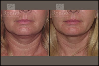 Acculift <span class=small>By Dr. Daniel Rousso</span> Before & After Gallery - Patient 2837802 - Image 4